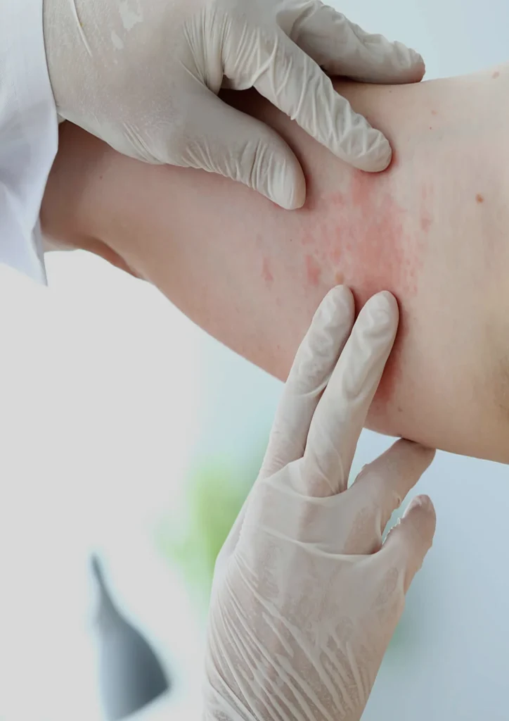 Doctor inspects a patient's rash on their arm during an allergy and immunology examination
